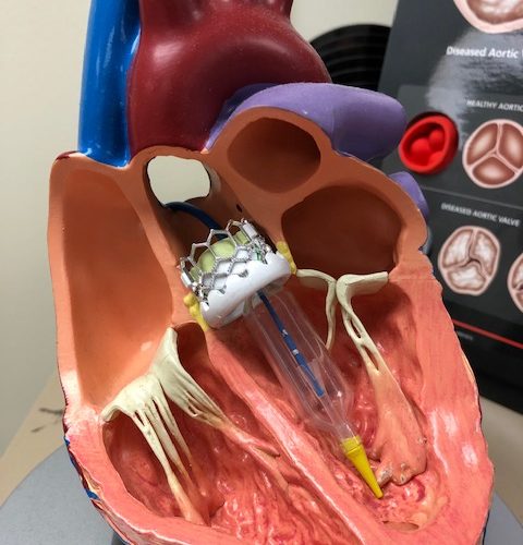 Aortic Valve Disease Aortic Valve Disease/ MyUSADr./ Second Medical Opinion/ Virtual Doctors
