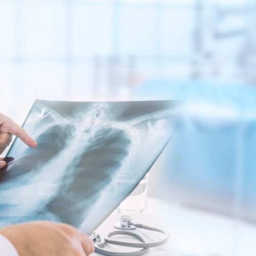 Lung Cancer treatment/ MyUSADr. Second Medical Opinion/ Virtual Doctor