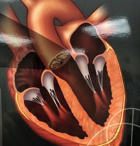 Mitral Valve Disease/ MyUSADr. / Virtual US based Specialists