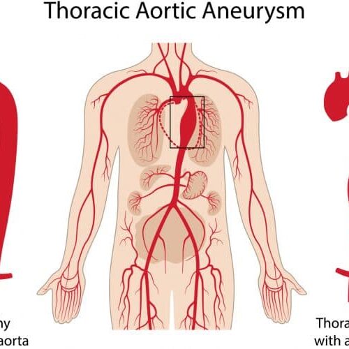 thoracic aortic aneurysm/ MyUSADr./ Access to US Based Specialists