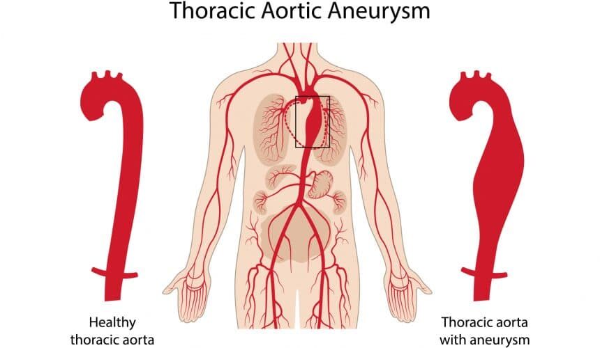 thoracic-aortic-aneurysm thoracic aortic aneurysm/ MyUSADr./ Access to US Based Specialists